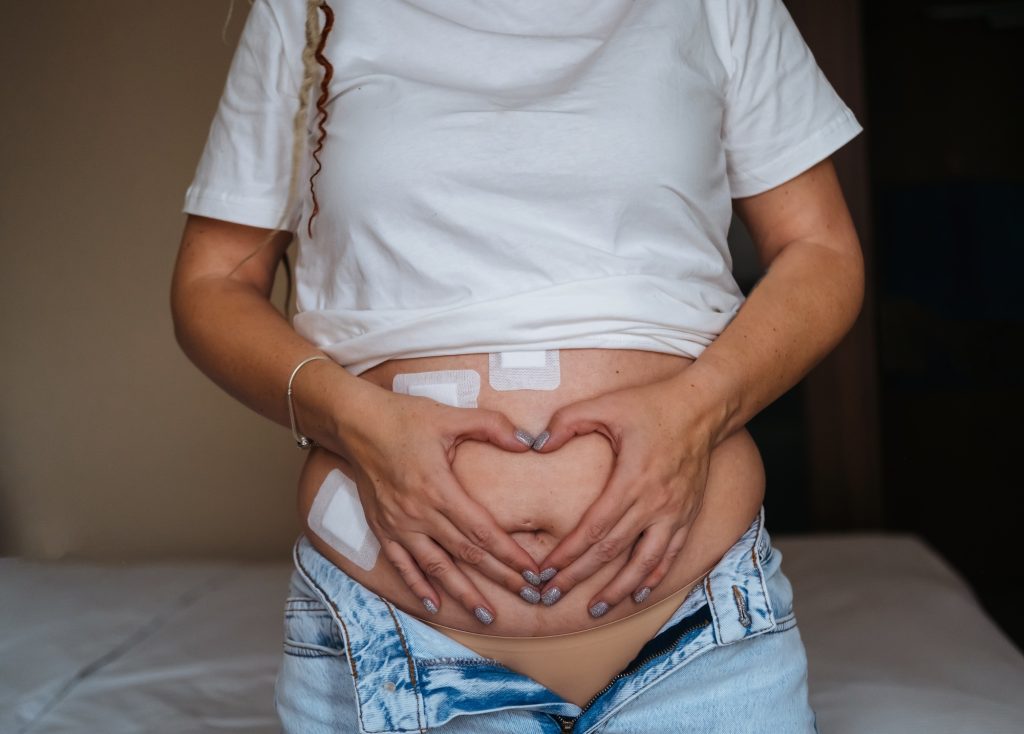 Woman's belly with scars after laparoscopic surgery. Removal of the gallbladder.
