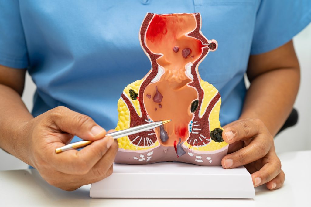 Asian doctor with rectum and hemorrhoid human anatomy model at hospital, inflamed vascular