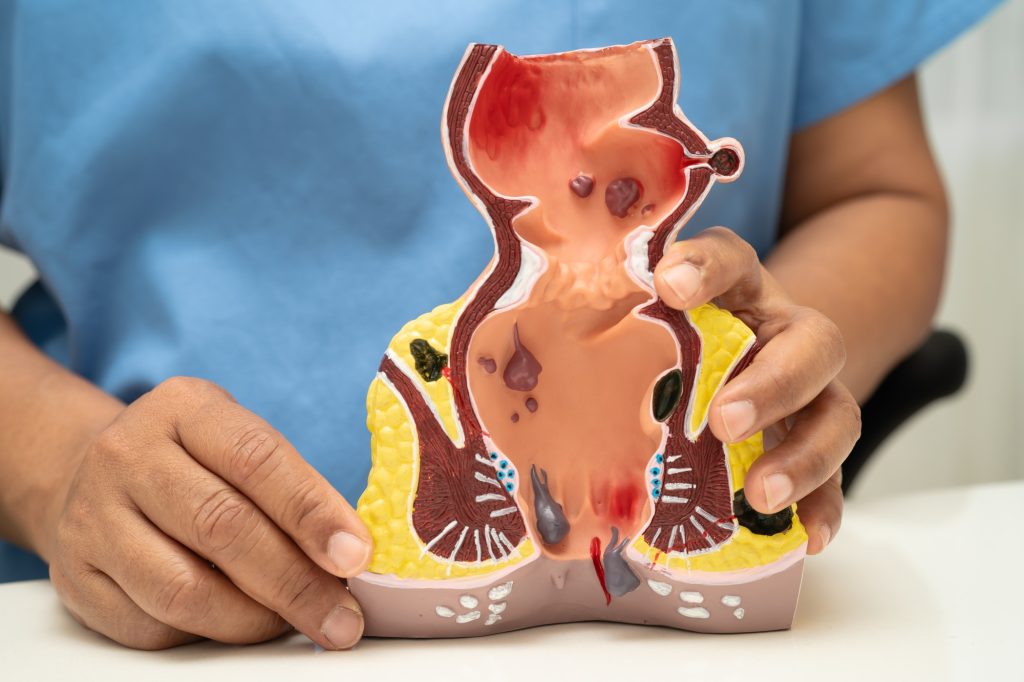 Asian doctor with rectum and hemorrhoid human anatomy model at hospital, inflamed vascular