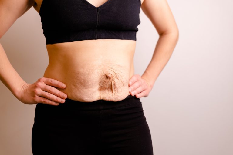 Abdomen de mujer con diástasis de rectos y hernia de la pared abdominal