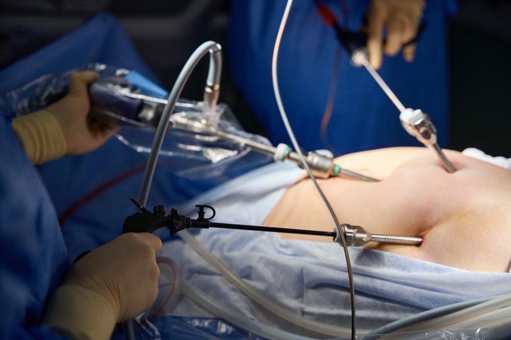 Surgical operation through small holes. Modern surgery. Laparoscopy