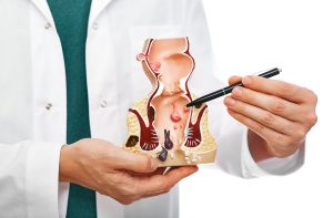Médico con bata blanca señala con un bolígrafo una maqueta anatómica del recto y el ano.